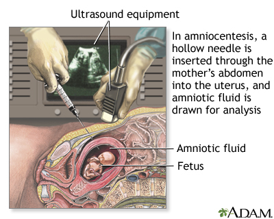 amniocentesis_ADAM