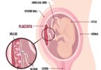 placenta anterior