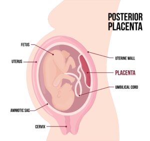 placenta posterior